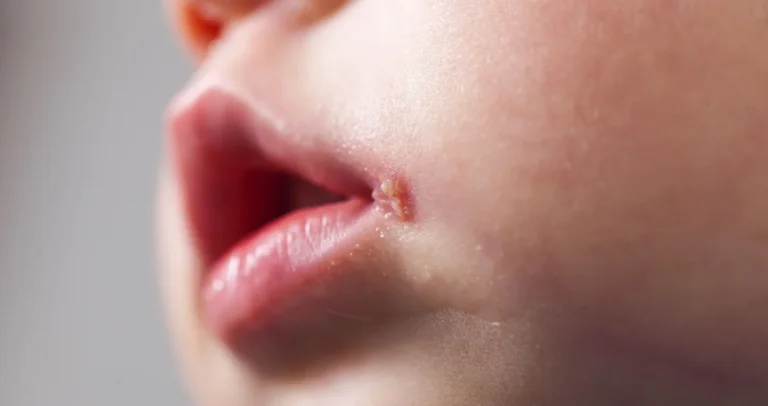 Korisni savjeti za zimu: Ovako možete držati herpes pod kontrolom