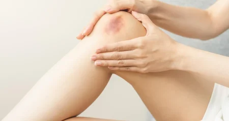 Modrice vam se pojavljuju niotkud? Možda vam nedostaje ovaj ključni vitamin